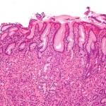 Gastritis_helicobacter